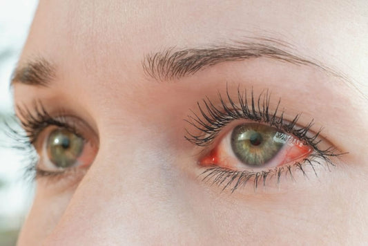 How to deal with allergic reaction to lash extensions?